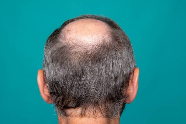 Is Turkey Hair Transplant FUE Safe? Expert Insights
